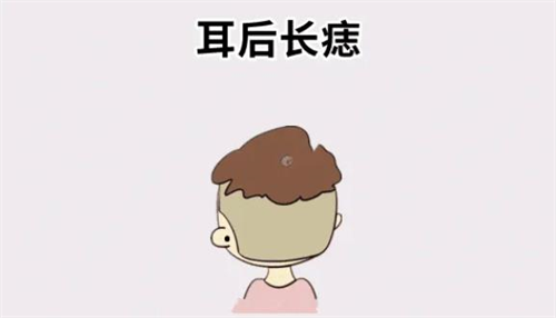 耳后有痣的代表什么 耳后有痣图解